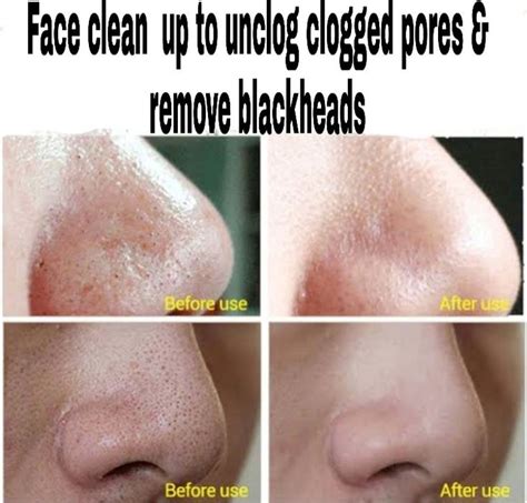 Clogged Pores All Over Face