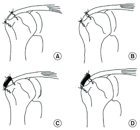 Illustration Of The Rotator Cuff Repair With Allograft Patch