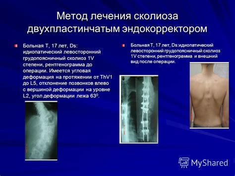 Презентация на тему: "ПРОФИЛАКТИКА И ЛЕЧЕНИЕ НАРУШЕНИЯ ОСАНКИ И ...