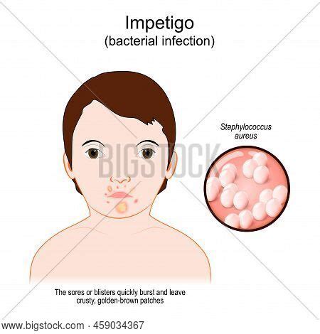 Impetigo. Bacterial Vector & Photo (Free Trial) | Bigstock