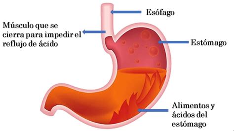 Acidez estomacal constante Cuál es el tratamiento 2025 Ideas de