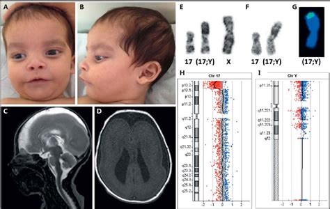 Miller-Dieker Syndrome due to a 5.5-Mb 17p Deletion in a 17;Y Pseudodicentric Chromosome ...