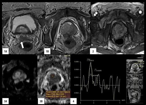 Role Of Magnetic Resonance Imaging Magnetic Resonance Spectroscopy And Transrectal Ultrasound