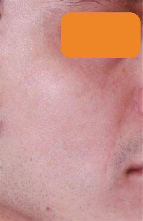 Keloid Scars Viplaserclinicmedspa