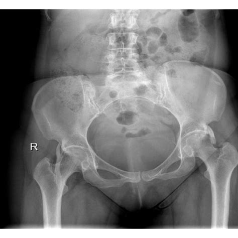 3d Bt Of The Pelvis Presenting Bilateral Heterotopic Ossification Masses Download Scientific