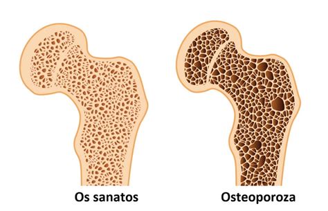 Intrebari Frecvente Despre Tratamentul Pentru Osteoporoza Cuore