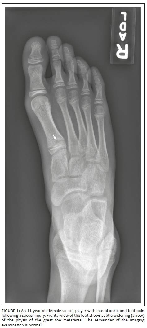 Soccer Toe Chronic Physeal Injury Of The Great Toe Metatarsal In A