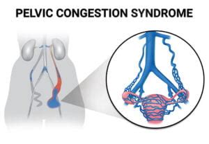 Pelvic Congestion Syndrome PCS Treatment Vein Endovascular