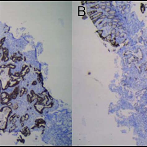 Colonic Biopsy Neoplastic Glands A Showing Diffuse Strong Positive