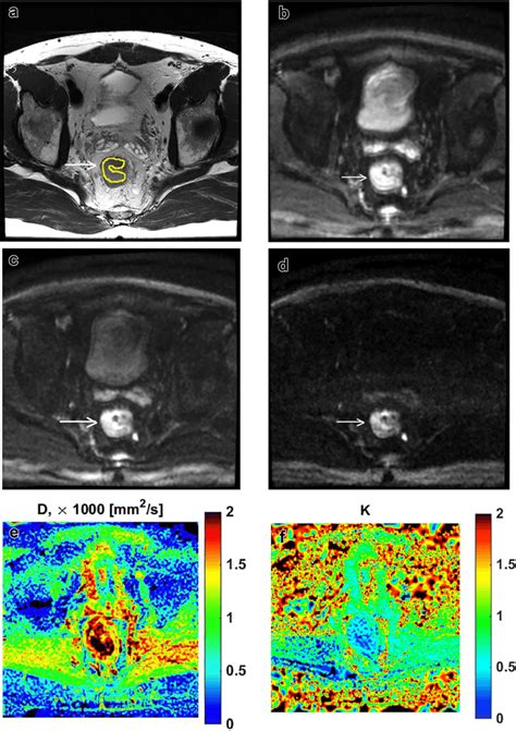 50 Year Old Male With Locally Advanced Rectal Cancer Axial T2 Weighted