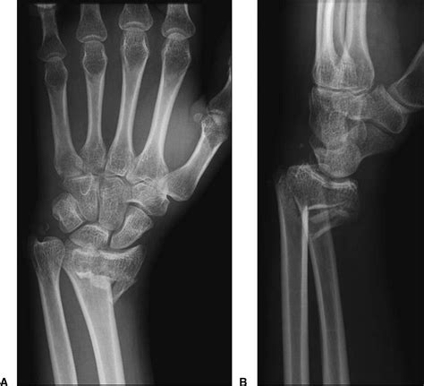 Radiographic Diagnosis Of Scapholunate Dissociation Among Intra