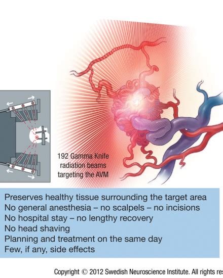 Arteriovenous Malformation AVM - SeattleNeurosciences.com