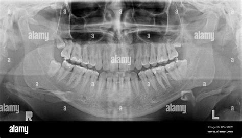 Panoramic X Ray Image Of Teeth Problem With Wisdom Tooth Stock Photo