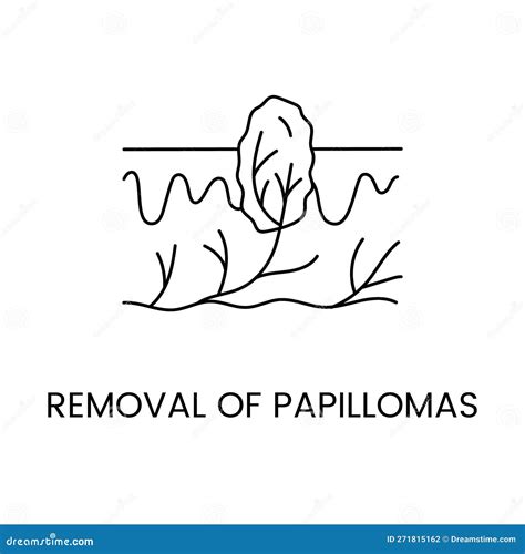 Removal Of Papillomas With The Help Of Laser Cosmetology, In Vector