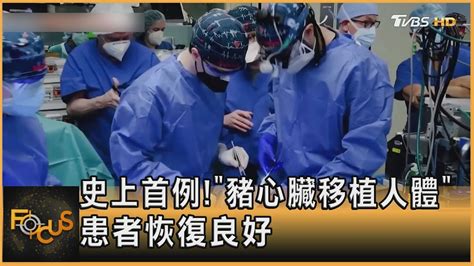 史上首例 「豬心臟移植人體」患者恢復良好｜方念華｜focus全球新聞 20220111 Youtube