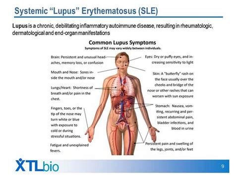 Systemic “lupus” Erythematosus Sle Lupus Is A Chronic Debilitating Inflammatory Autoimmune