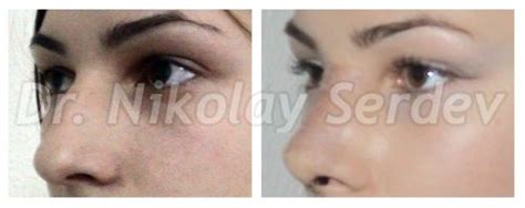 Pin On Scarless Cheekbone Lift By Serdev Sutures®