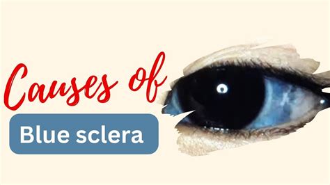 Blue Sclera Causes And Mnemonics Explained YouTube