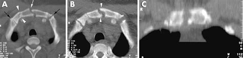 A Case Report Of An Unusual Sternal Fracture Emergency Medicine Journal