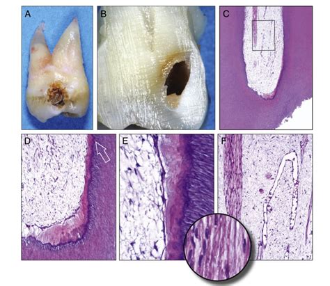 Correlation Between Clinical And Histologic Pulp Diagnoses IDental Study