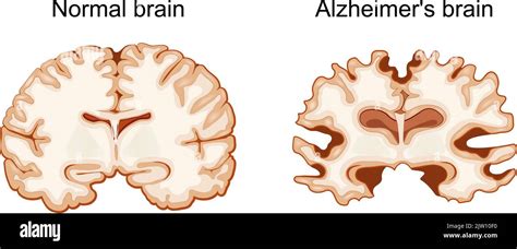 Normal Brain And Alzheimers Brain Neurodegenerative Disease Vector