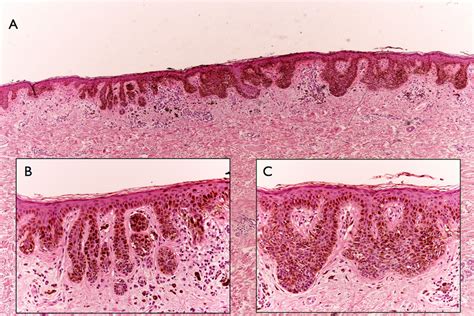 A On Histology There Is A Diffuse Lentiginous Proliferation Made Up