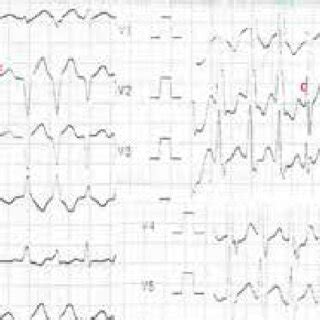 Surface 12 Lead Electrocardiogram Showing Ventricular Tachycardia With