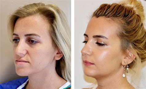 Jaw Surgery Procedure Providers Photos Cost Belorens