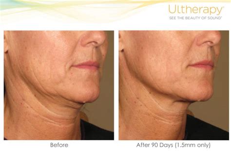 Ultherapy Toronto Ultherapy Glow Treatment Toronto Skin Tightening