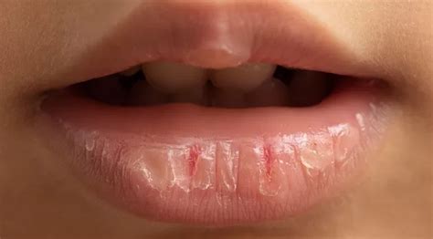 ¿por Qué Se Resecan Los Labios Y Cómo Mantenerlos Hidratados America Noticias