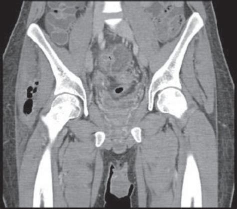 Figure Tender Thigh In A Patient With Crohn S Disease Open I