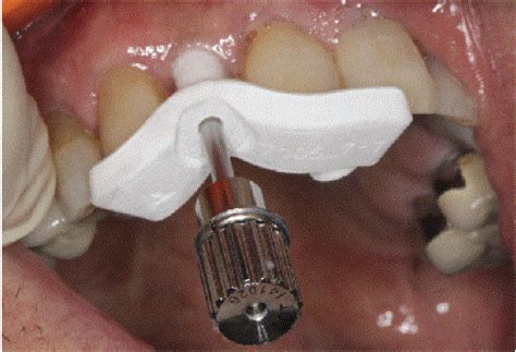 Immediate Implant Placement In Extraction Socket With An Adapted