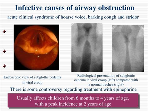 Ppt Upper Airway Obstruction In Pediatric Patient S From