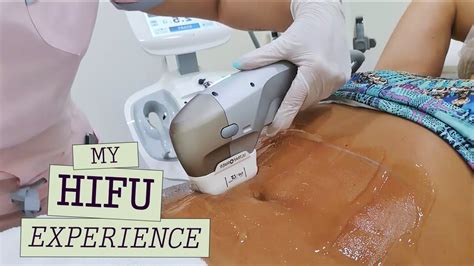 Ultraformer Hifu Body Treatment My Transformation With High