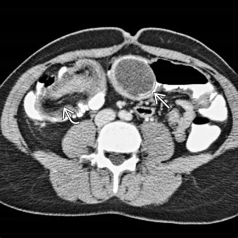 Mucocele Of The Appendix Radiology Key