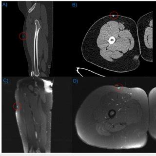 Pre Operative CT And MRI Contrasted CT And MRI Of The Right Lower