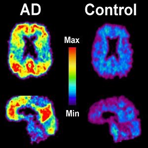 Osel Cz Formaldehyd Ako Indik Tor Alzheimerovej Choroby