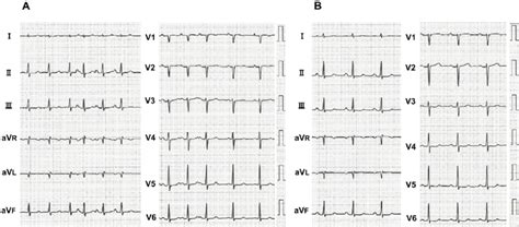 Figure1 Twelve Lead Electrocardiograms Obtained Before A And 5 Months Download Scientific