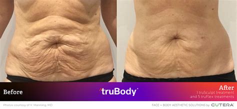 Trusculpt Vs Coolsculpting Tasmania Body Contouring