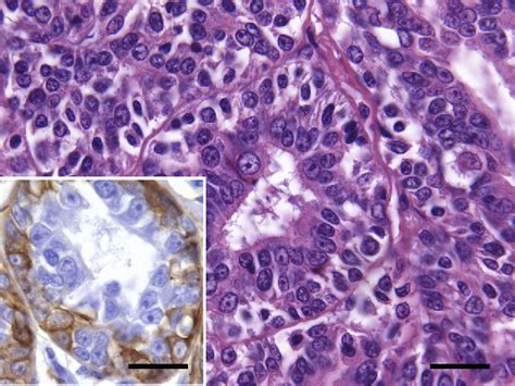 Figure 3 From Salivary Gland Epithelial Myoepithelial Carcinoma With