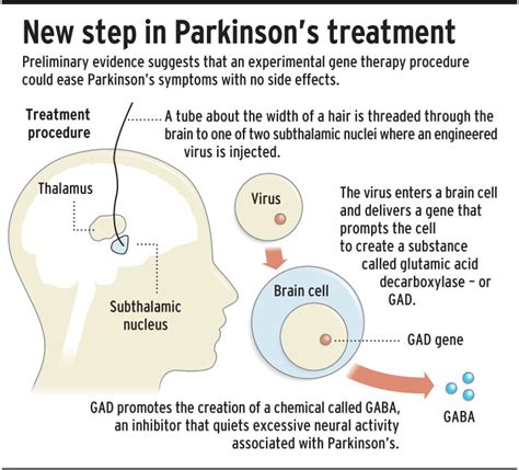 New Treatments For Parkinsons Disease 2024 Nessi Paloma