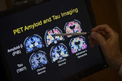 Eli Lilly S New Alzheimer S Drug Shows Promise Of Slowing Down Memory