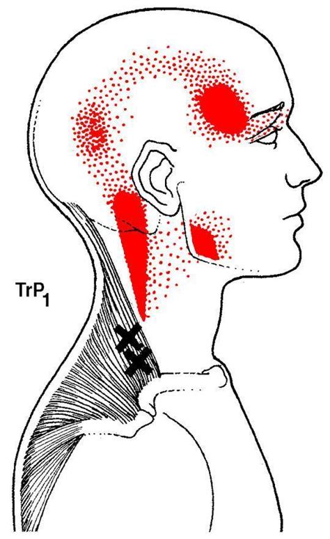 Addressing Headaches Through Muscles Scarsdale Health And Wellness