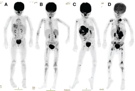 Frontiers Comparing The Diagnostic Value Of F Fdg Pet Ct Scan And