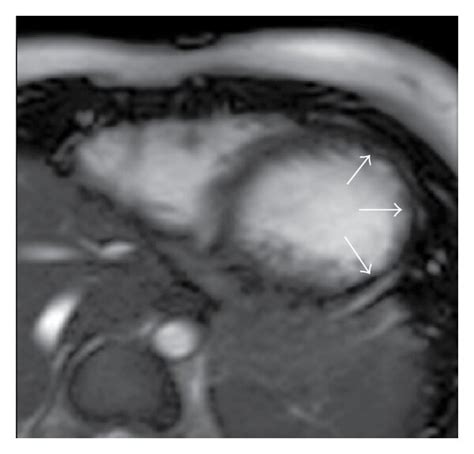 Cardiac Magnetic Resonance Cmr Imaging Showing Short Axis Views In