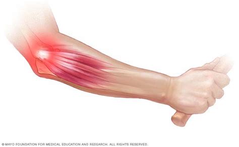 Lateral Elbow Tendinopathy Tennis Elbow Physiosteps