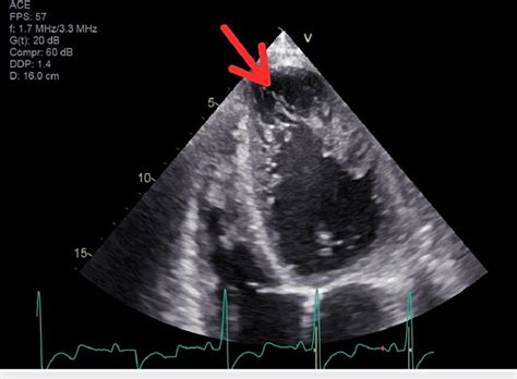 Apical Four Chamber View On Transthoracic Echocardiography Showing