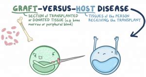 Graft Versus Host Disease (GVHD) | CFCH | Centre for Clinical Haematology