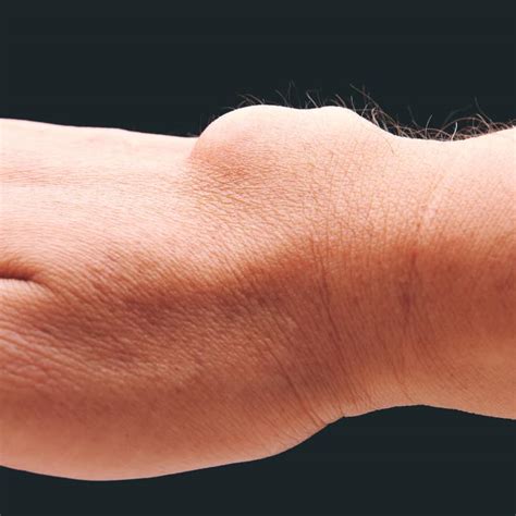 Ganglion Cysts Symptoms Causes And Treatment 57 Off