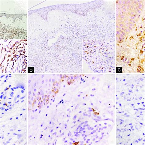 A Photomicrograph Showing Cd68 Immunopositivity ×100 Inset Showing Download Scientific